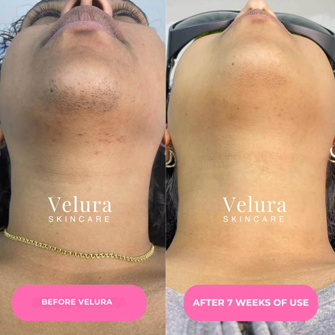 Velura® Cyperus Rotundus Serum